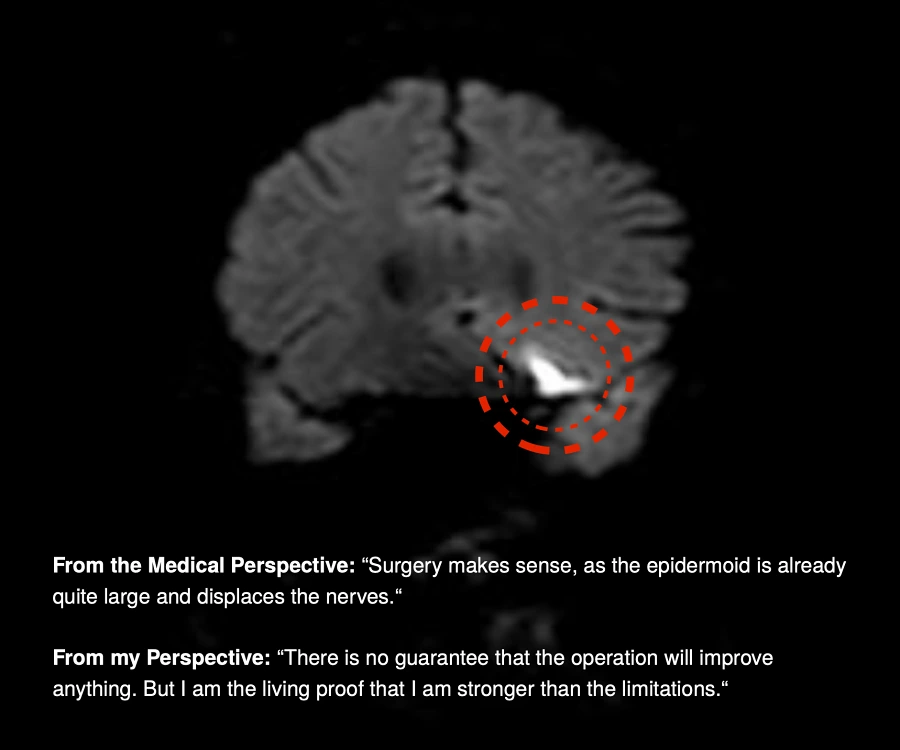 Epidermoid Cyst Tumor